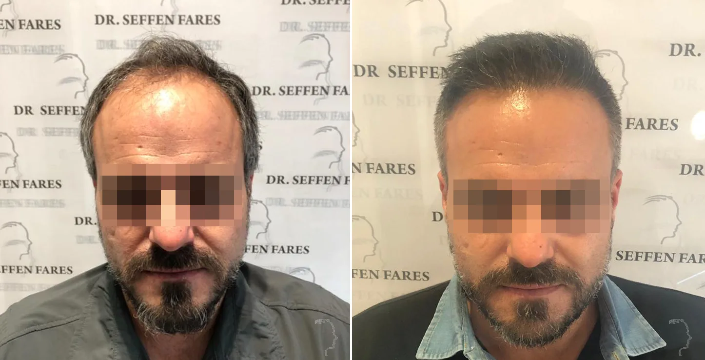 Patient 26, before and after hair transplant, view 3