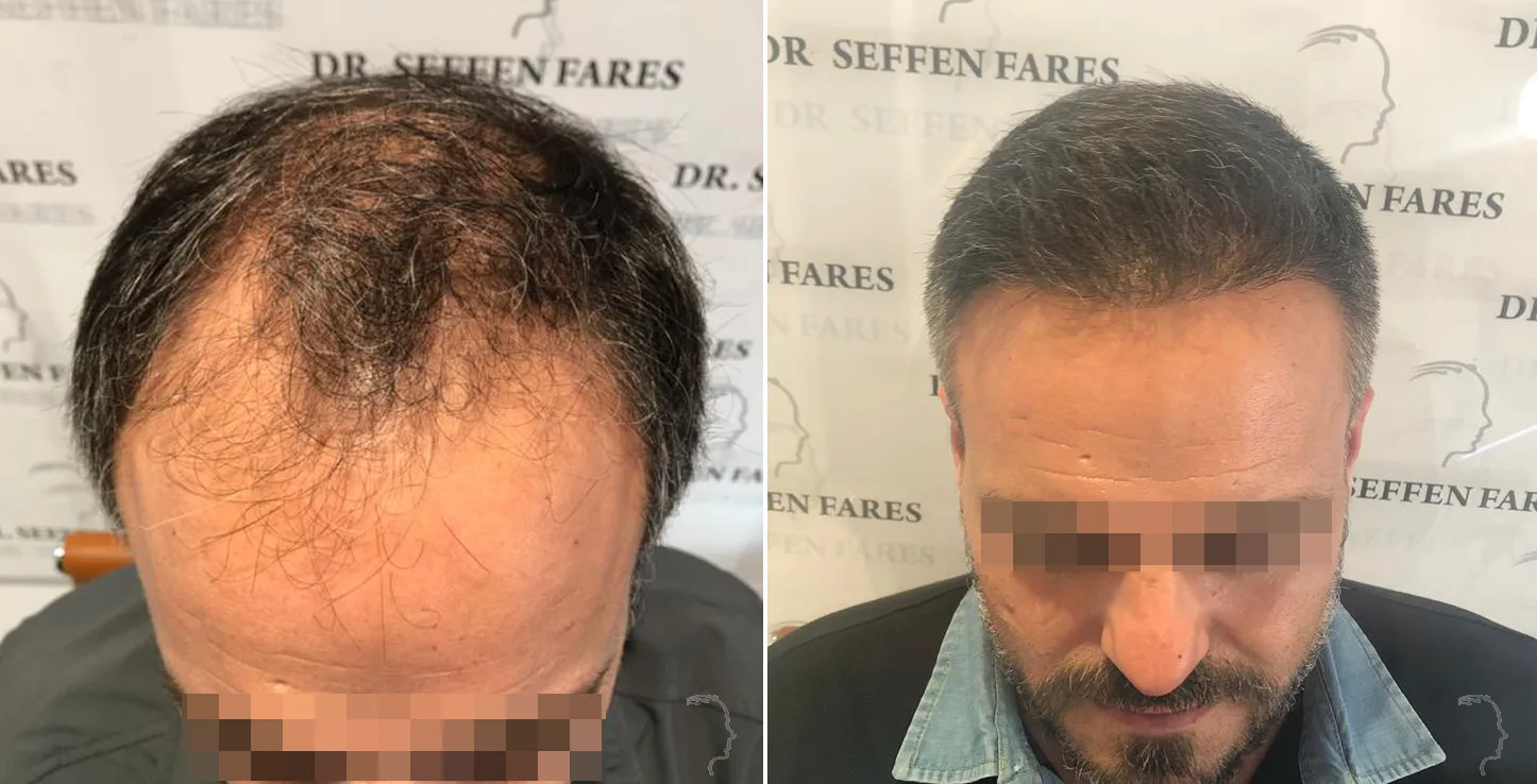 Patient 26, before and after hair transplant, view 2