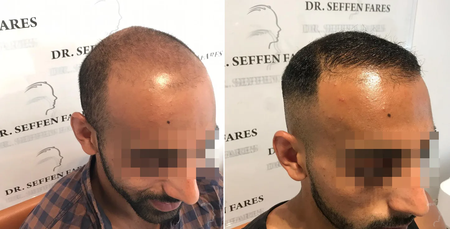 Patient 27, before and after hair transplant, view 1
