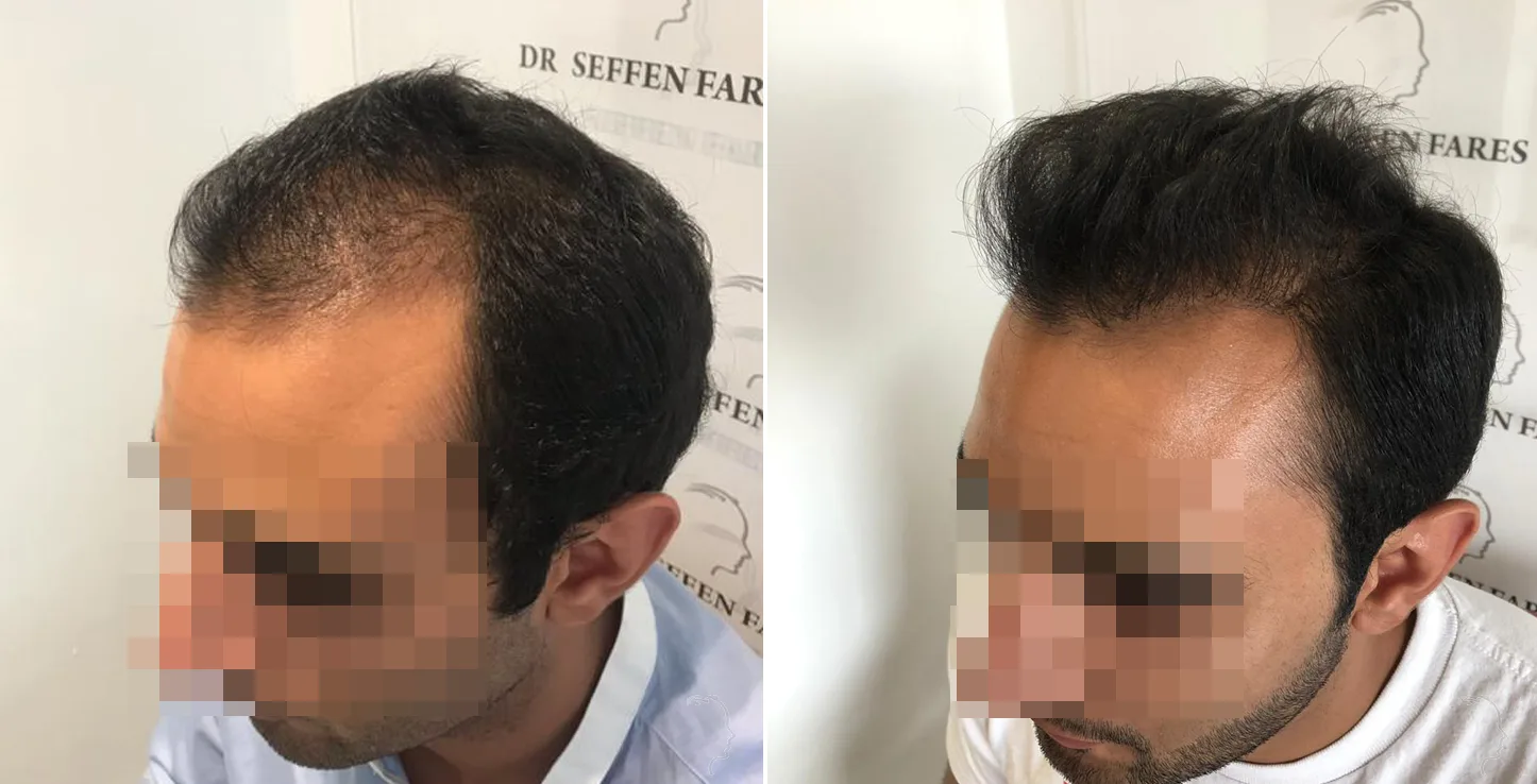Patient 28, before and after hair transplant, view 2