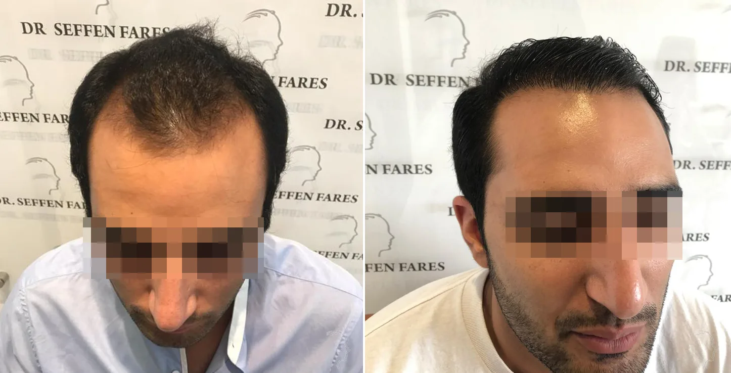 Patient 28, before and after hair transplant, view 1