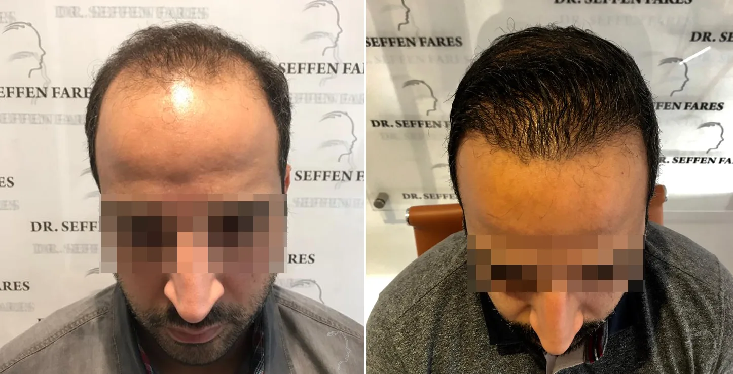 Patient 30, avant et après greffe de cheveux, vue 1