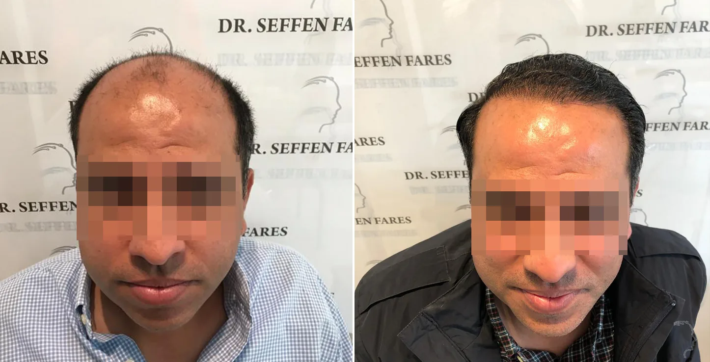 Patient 31, before and after hair transplant, view 1