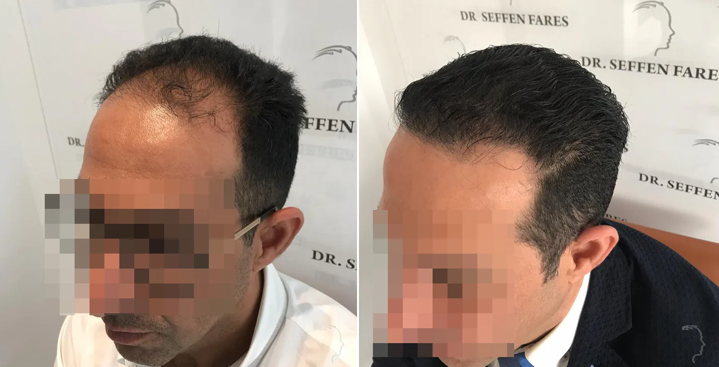 Patient 33, before and after hair transplant, view 2