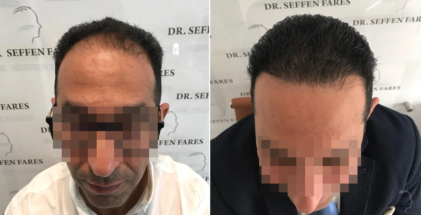 Patient 33, before and after hair transplant, view 1