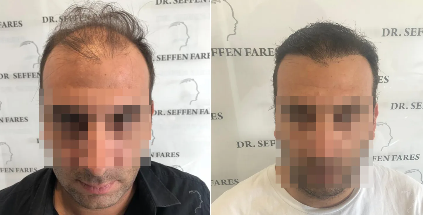 Patient 34, before and after hair transplant, view 1
