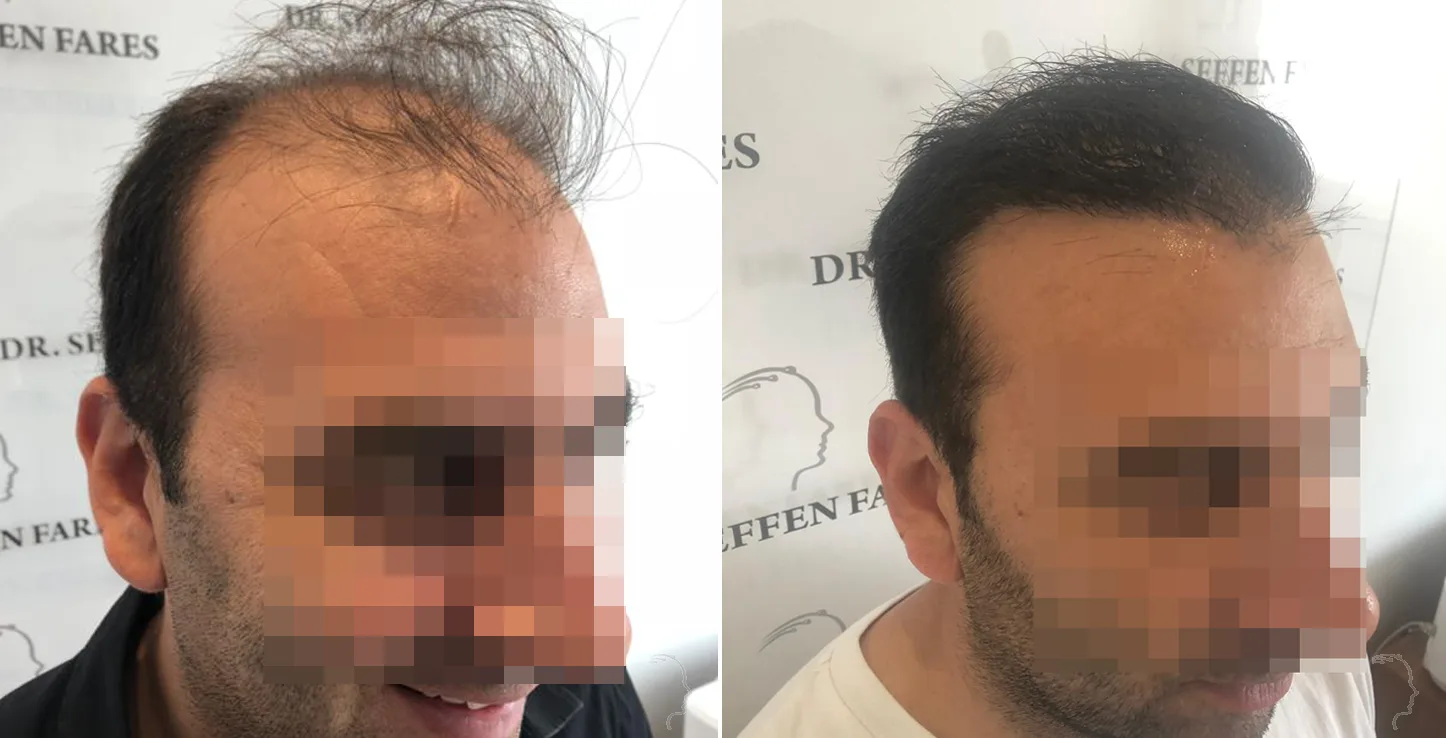 Patient 34, before and after hair transplant, view 2