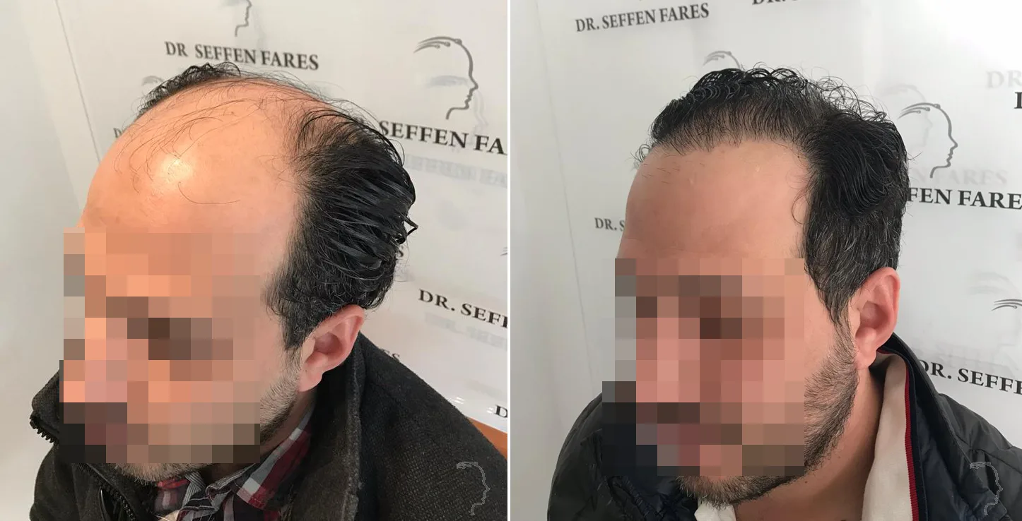 Patient 35, before and after hair transplant, view 2