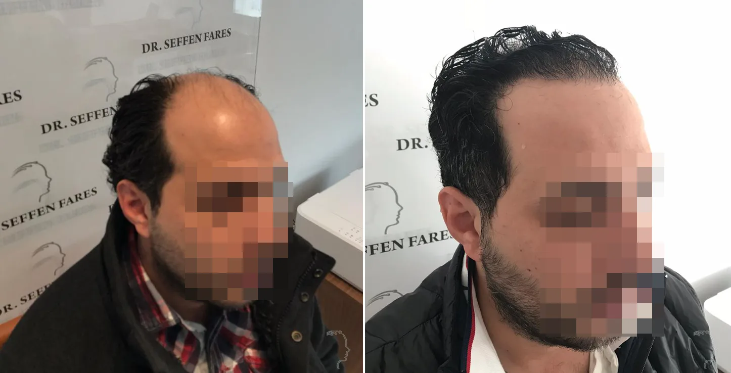 Patient 35, before and after hair transplant, view 1