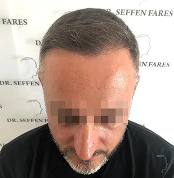 Patient 25, après greffe de cheveux