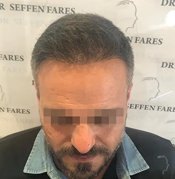 Patient 26, après greffe de cheveux