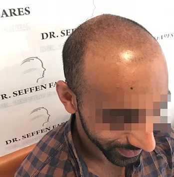 Patient 27, après greffe de cheveux