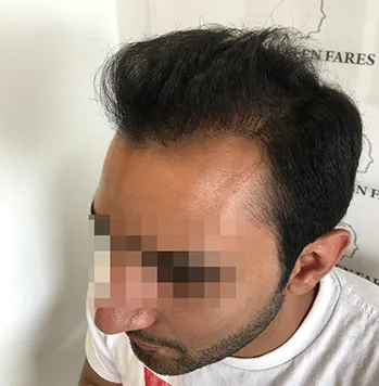 Patient 28, après greffe de cheveux