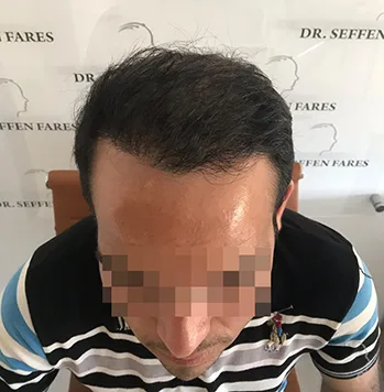 Patient 29, après greffe de cheveux