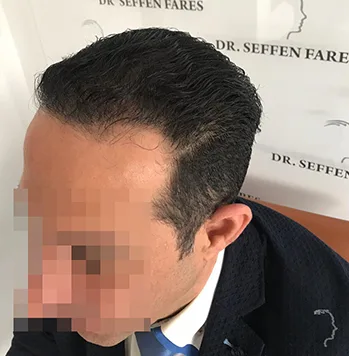 Patient 33, après greffe de cheveux