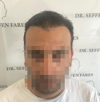 Patient 34, après greffe de cheveux