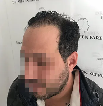 Patient 35, après greffe de cheveux
