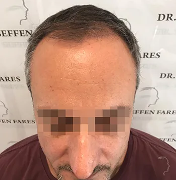 Patient 25, avant greffe de cheveux