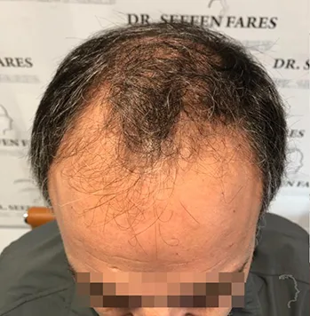 Patient 26, avant greffe de cheveux