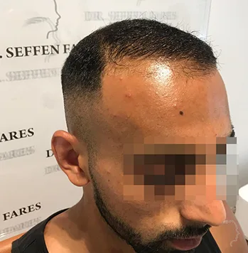 Patient 27, avant greffe de cheveux