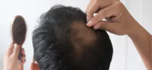 Causes of hair loss