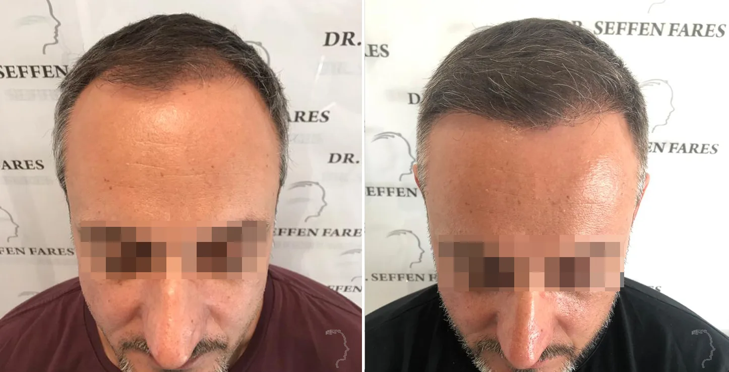 Patient 25, before and after hair transplant, view 2