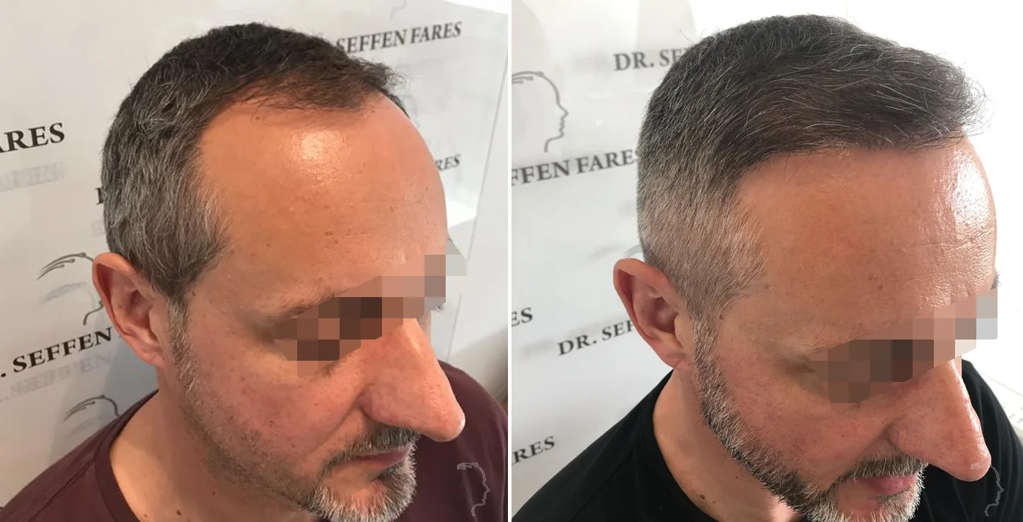 Patient 25, before and after hair transplant, view 1