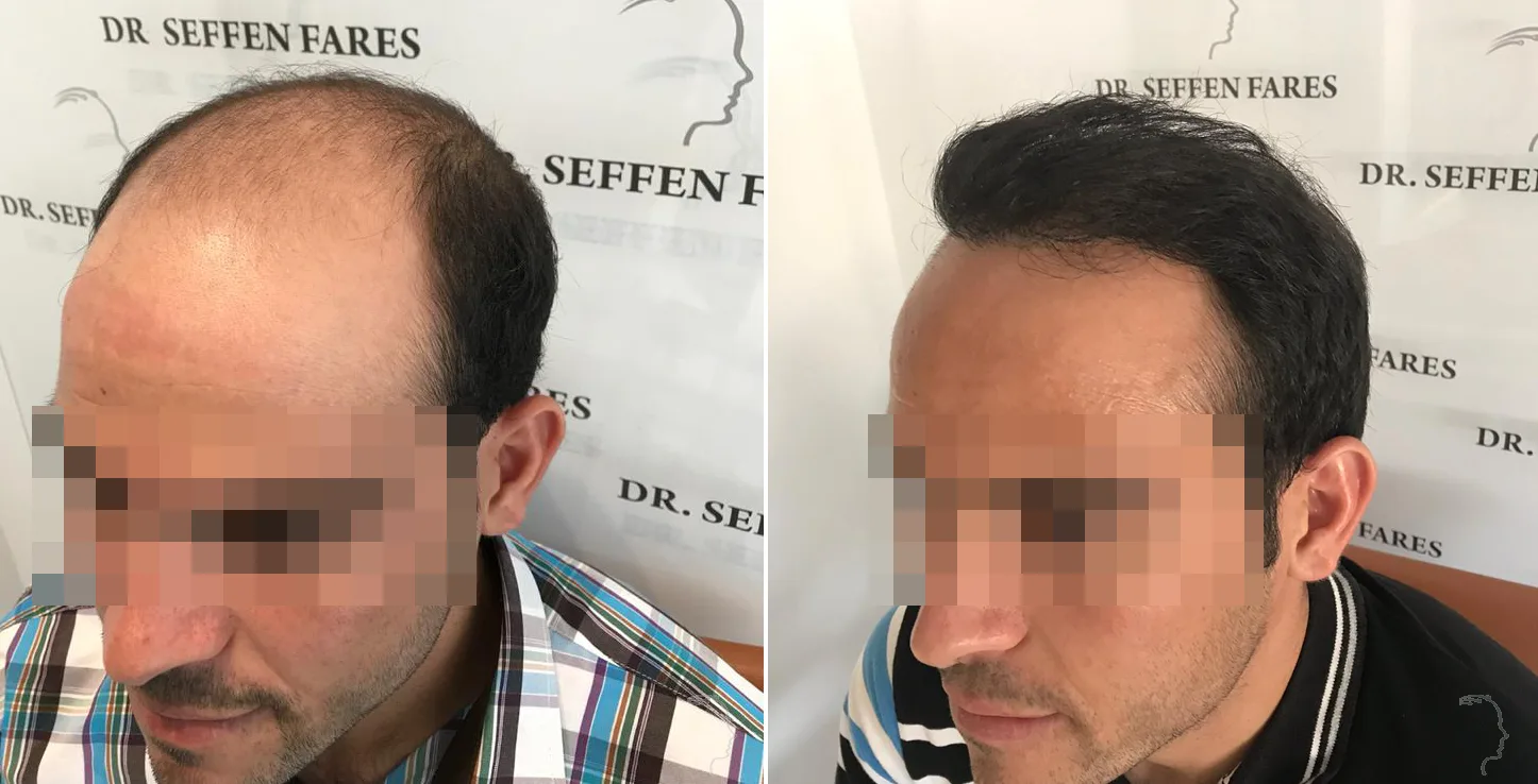 Patient 29, before and after hair transplant, view 2