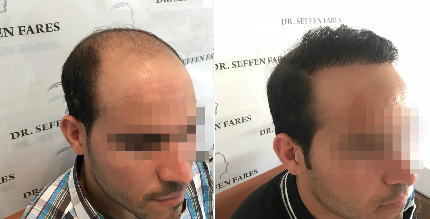 Patient 29, before and after hair transplant, view 3