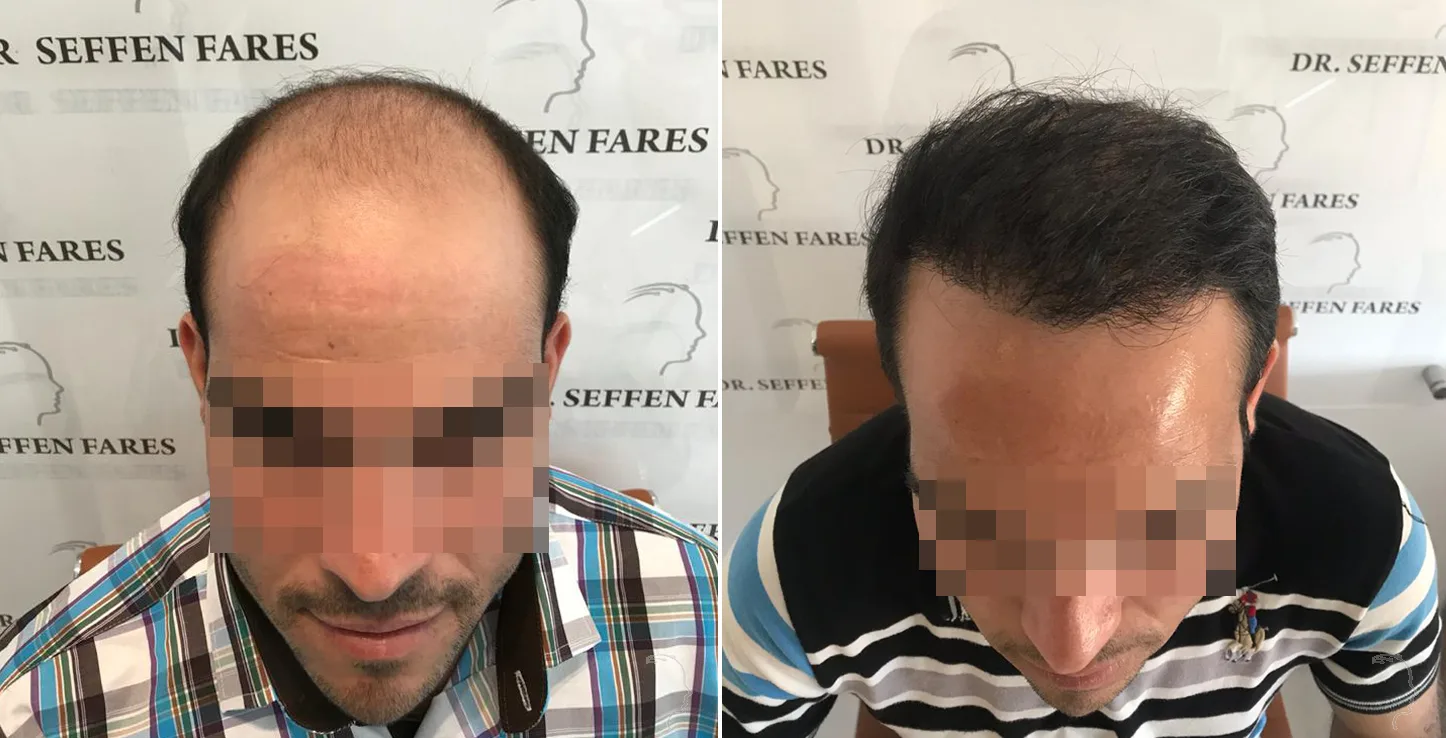 Patient 29, avant et après greffe de cheveux, vue 1