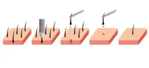 FUE hair restoration