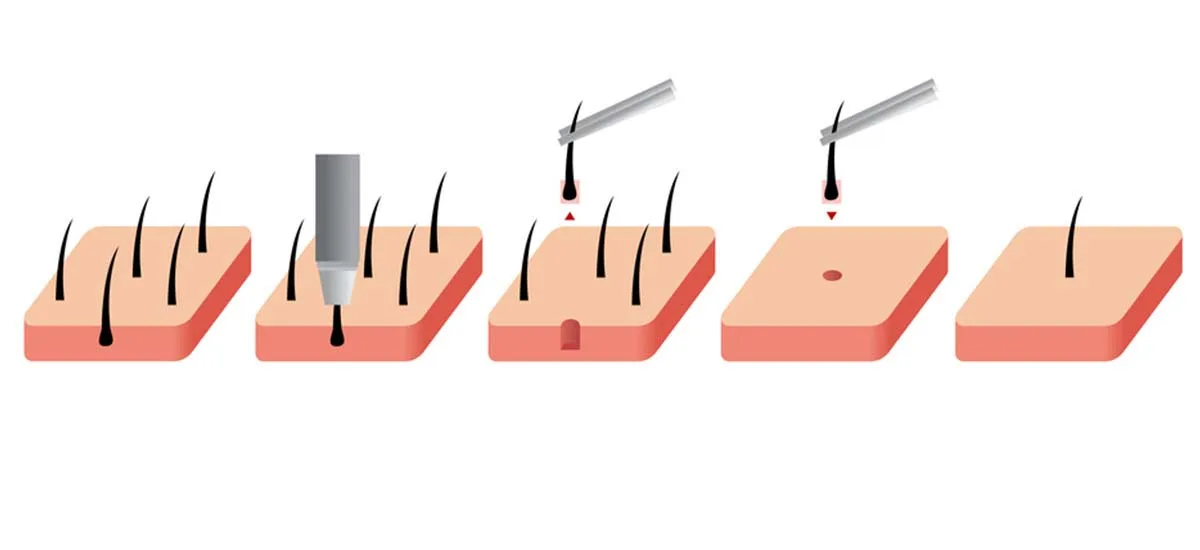 FUE hair restoration: beard, eyebrows and body