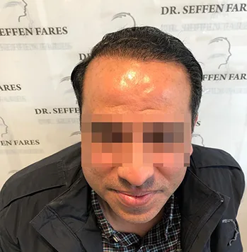 Patient 31, après greffe de cheveux