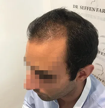 Patient 28, avant greffe de cheveux