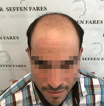 Patient 29, avant greffe de cheveux