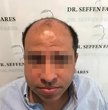 Patient 31, avant greffe de cheveux