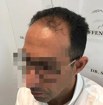 Patient 33, avant greffe de cheveux
