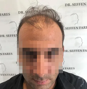 Patient 34, avant greffe de cheveux