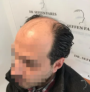 Patient 35, avant greffe de cheveux