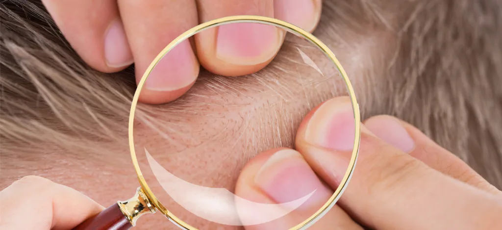 Myths about hair loss