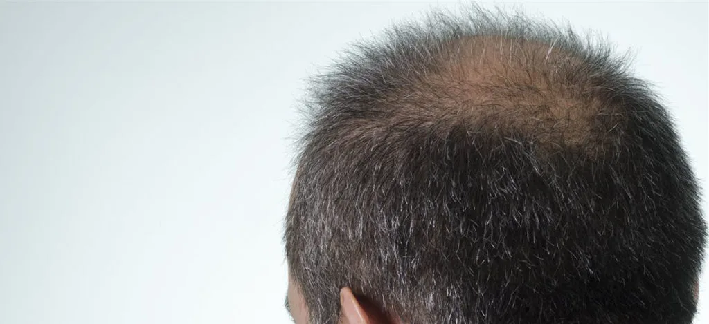 Hair restoration in Tunisia