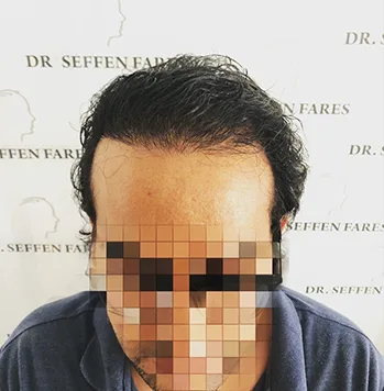 Patient 36, après greffe de cheveux