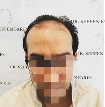 Patient 36, avant greffe de cheveux