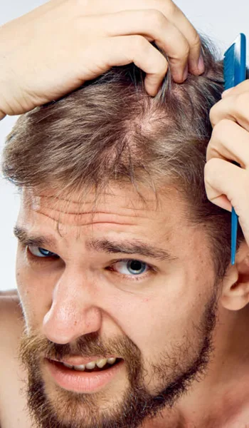 Hair loss in men