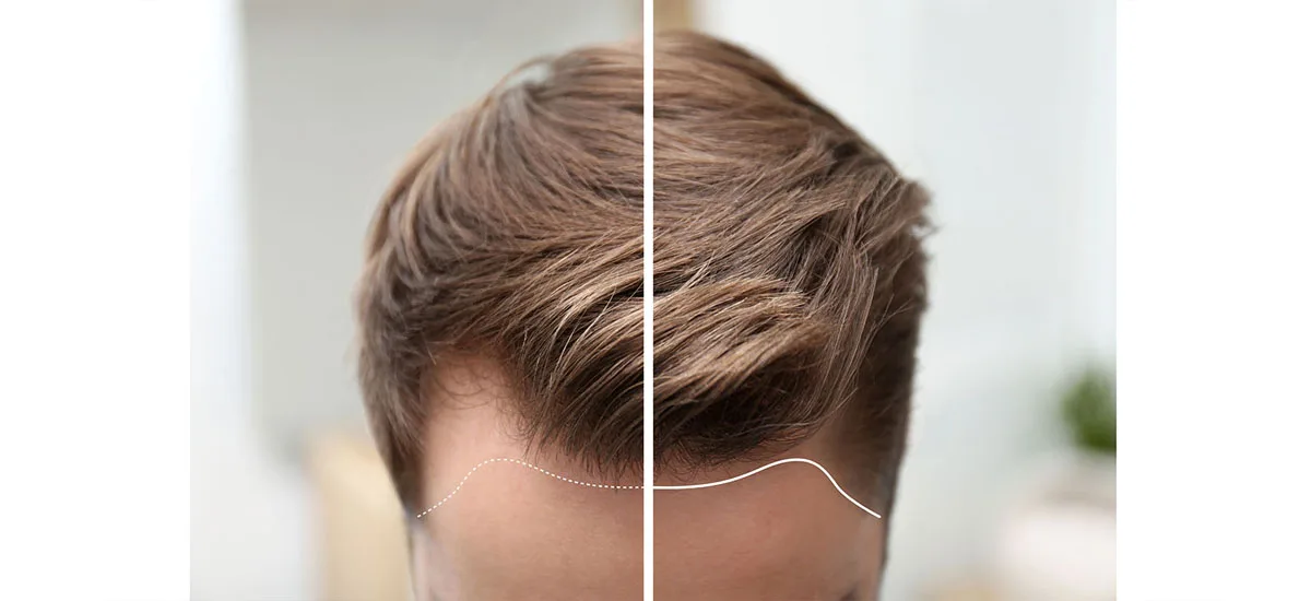 Hair transplant: age, results and price