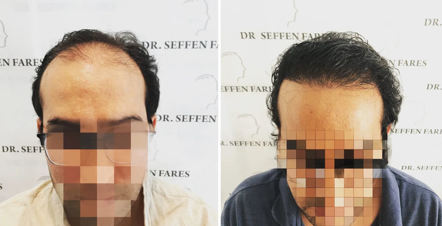 Patient 36, before and after hair transplant, view 1