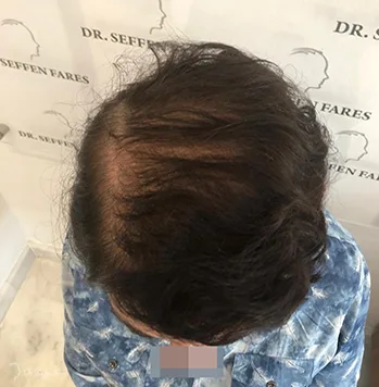 Après greffe de cheveux
