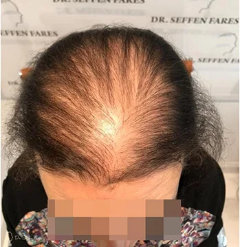 Avant greffe de cheveux