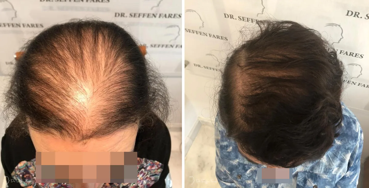 Patient 37, before and after hair transplant, view 2