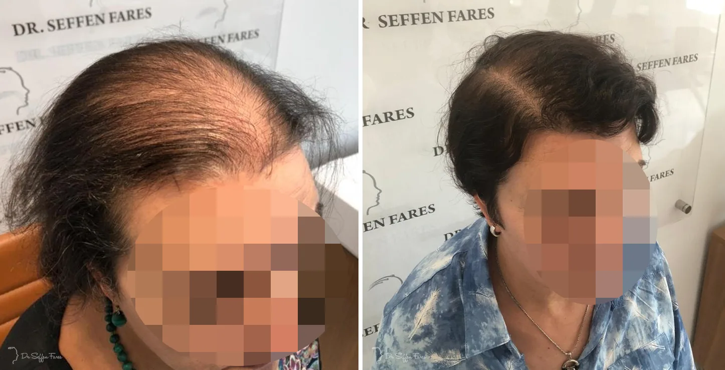 Patient 37, before and after hair transplant, view 3